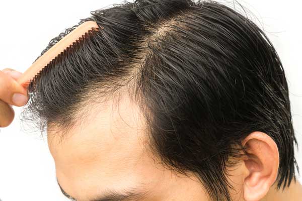 12 Home Remedies for Hair Loss Prevention and Regrowth