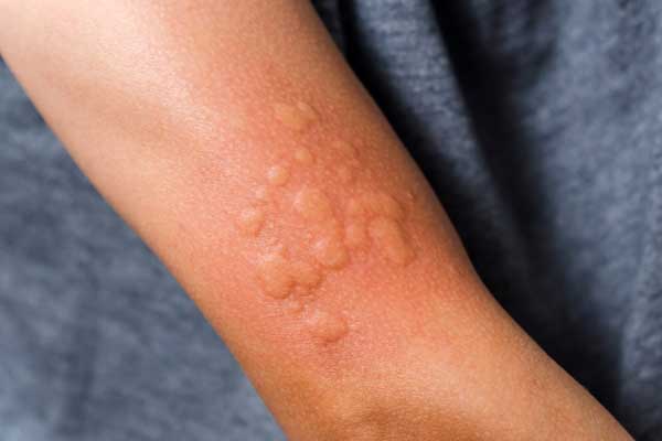 What Causes Hives and How to Find Relief from the Itching and Discomfort